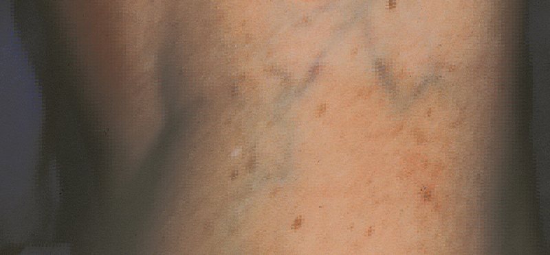 Vein Therapy Austin TX