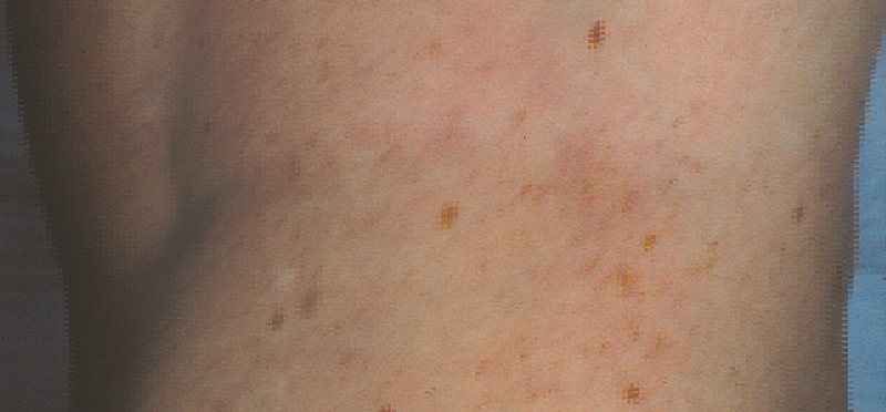 Vein Therapy Austin TX