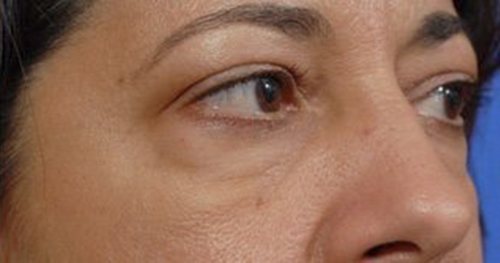 Eyelid Surgery Austin TX