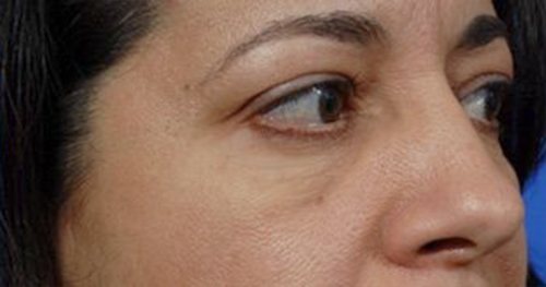 Eyelid Surgery Austin TX