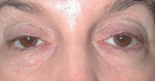 Eyelid Surgery Austin TX