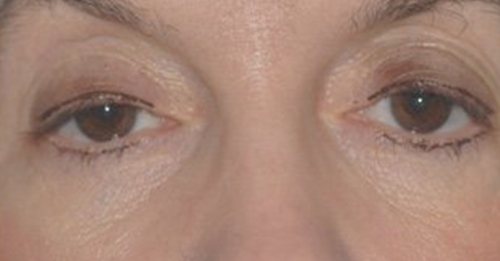 Eyelid Surgery Austin TX