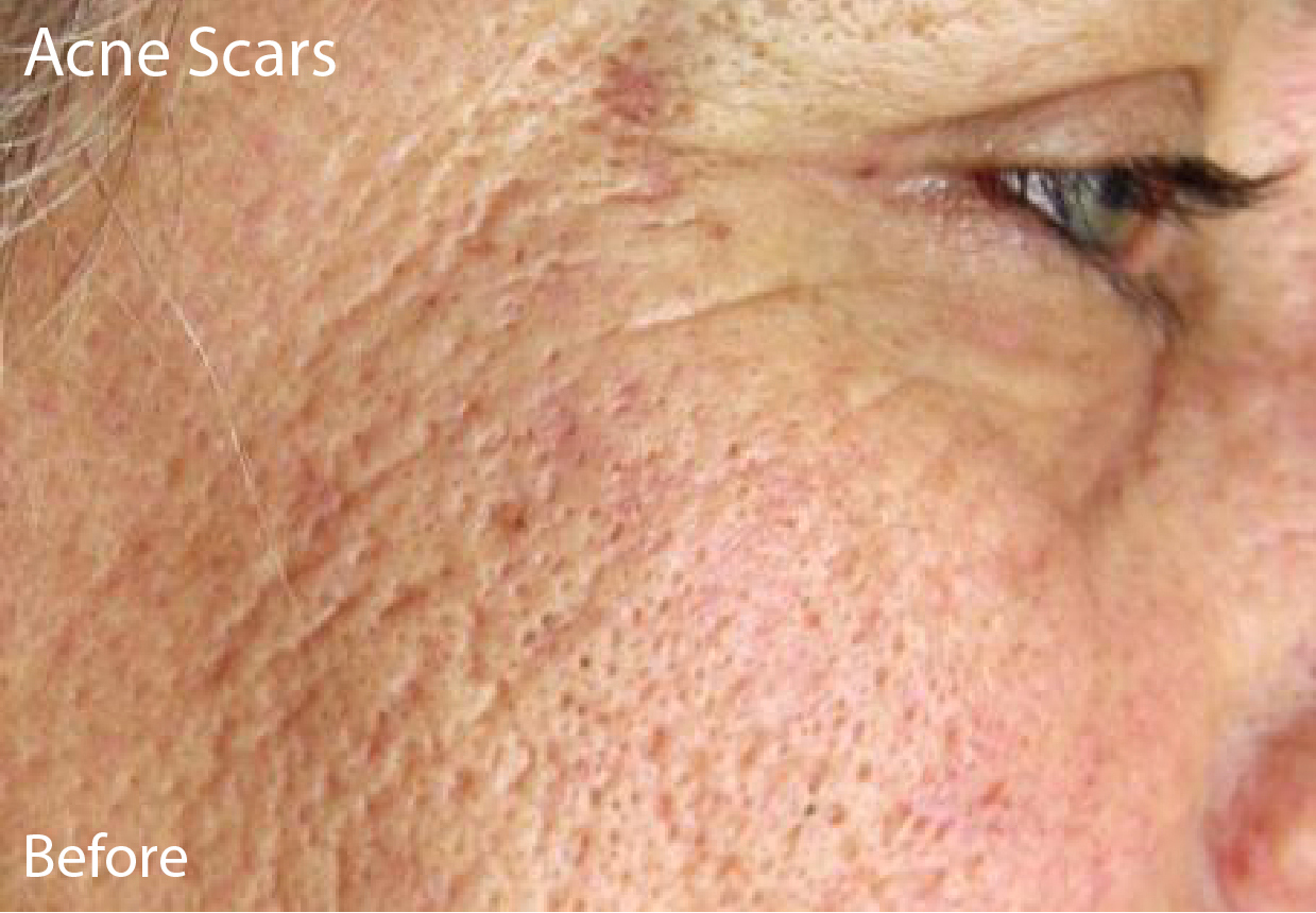 Fractional Laser Resurfacing Austin TX