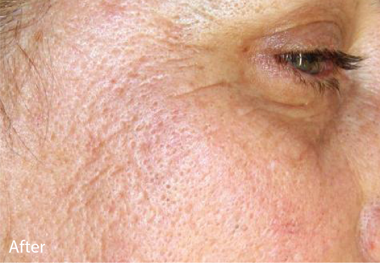 Fractional Laser Resurfacing Austin TX