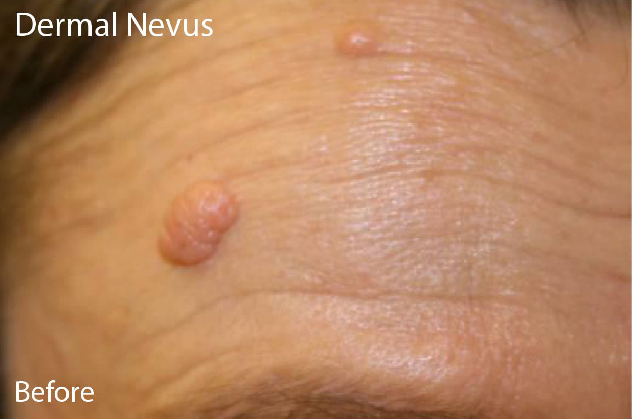 Fractional Laser Resurfacing Austin TX