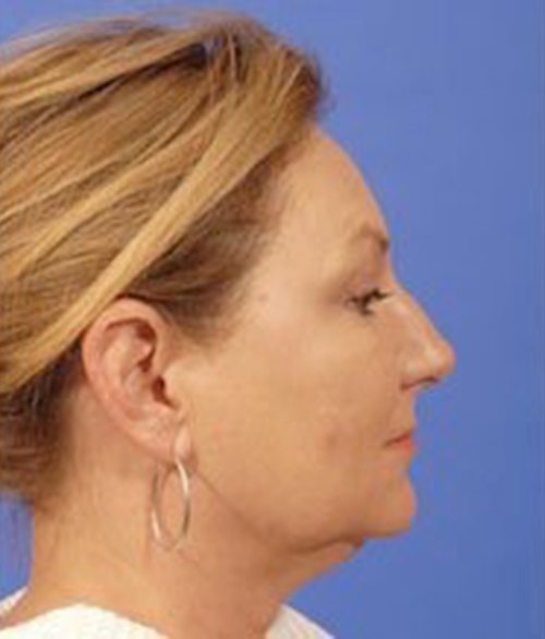 Facial Fat Grafting Austin TX