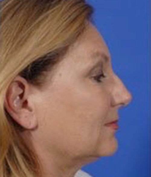 Facial Fat Grafting Austin TX