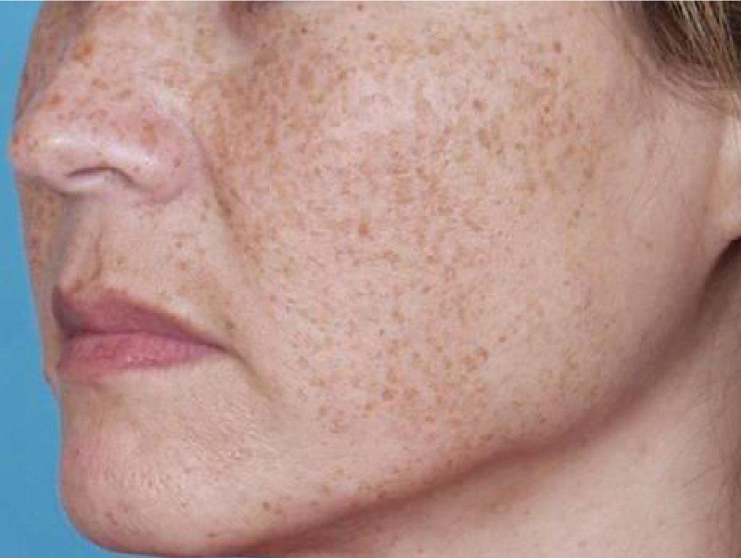 IPL Photofacial Austin TX