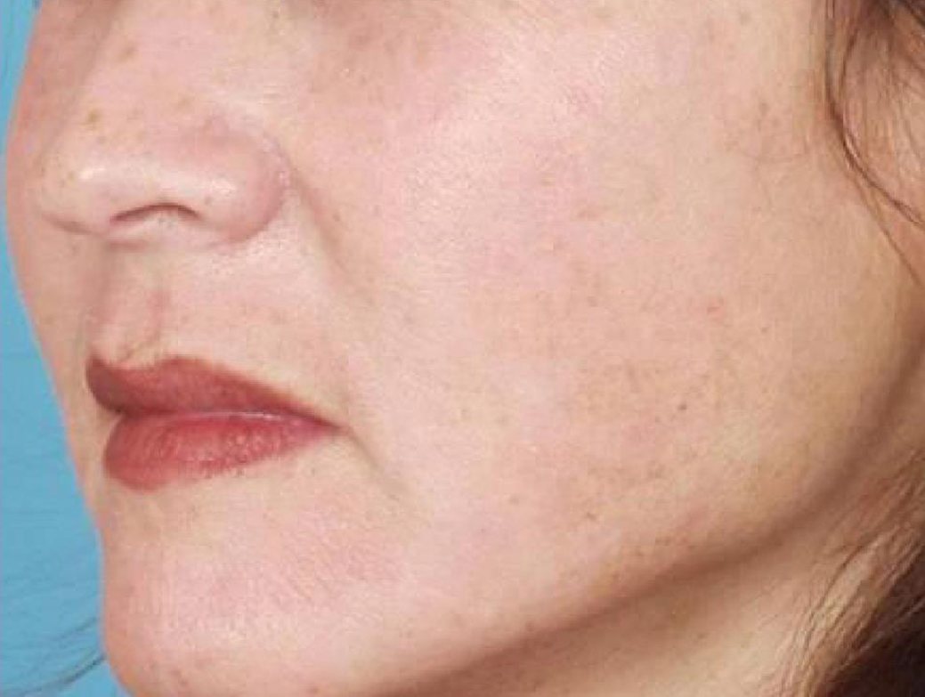 IPL Photofacial Austin TX