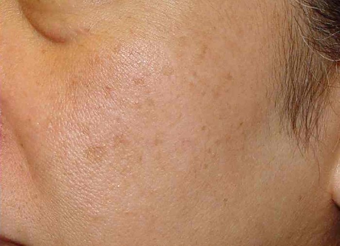 IPL Photofacial Austin TX