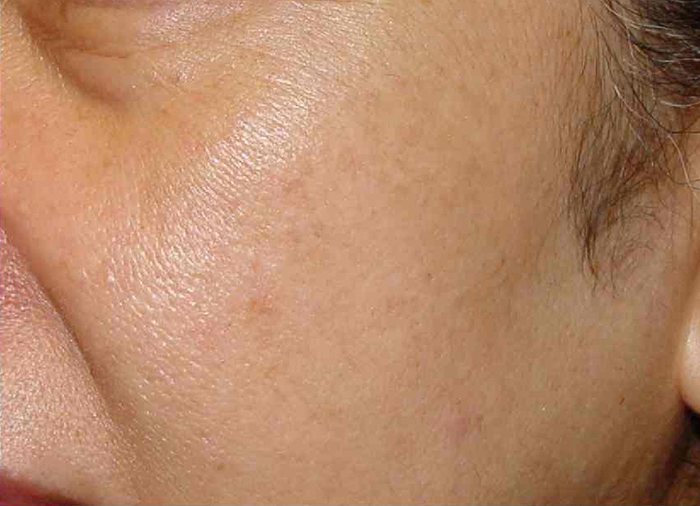 IPL Photofacial Austin TX