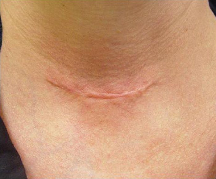 Laser Genesis Skin Therapy Austin TX