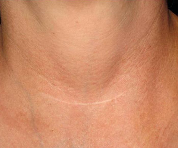 Laser Genesis Skin Therapy Austin TX