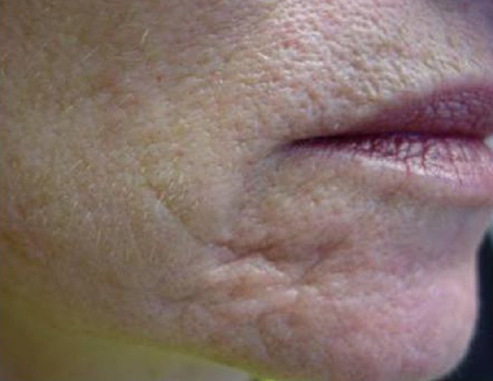 Laser Genesis Skin Therapy Austin TX