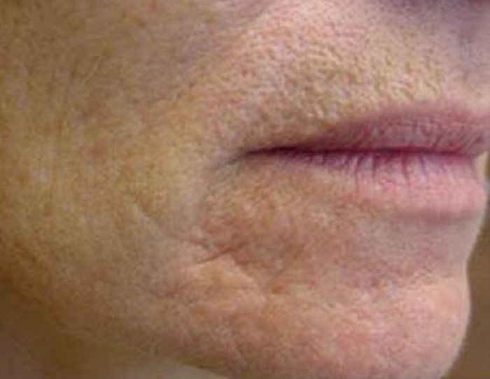 Laser Genesis Skin Therapy Austin TX