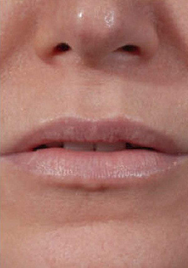 Lip Enhancement Austin