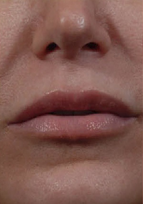 Lip Enhancement Austin